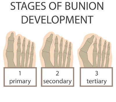 Bunions