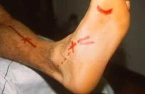 Shin Pain & Pronation