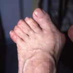Bunion and adducted lesser toes