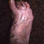 Changed foot shape because of Charcot Marie tooth