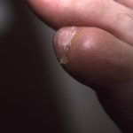 corn at edge of toenail