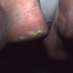 Cracked heel callus