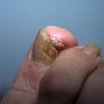 Fungal infection of toenail and verrucae under toenail