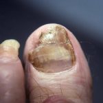 Fungally infected toenail