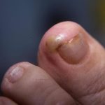 ingrowing toe nail with pus