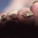 Long nail cutting into adjacent toe