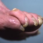 Long toenails and corn on top of 4th toe