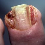 Nasty Ingrowing Toe Nail