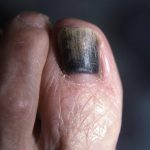 Old blackened toenail being pushed off by new nail underneath
