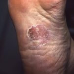 Tinea in arch of foot