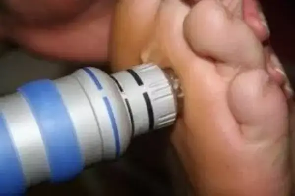 Shockwave Therapy Melbourne